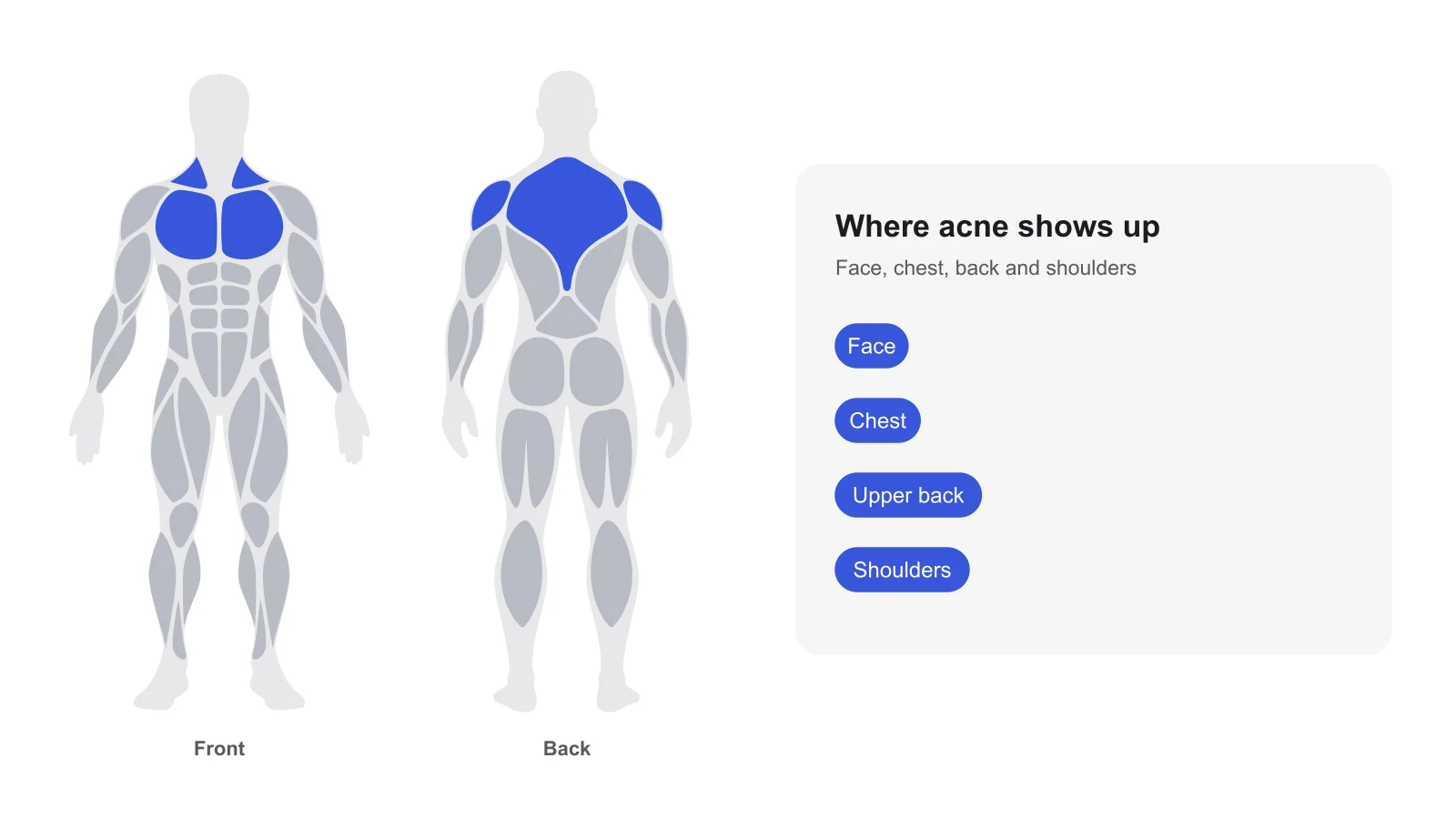 Front and back body outlines with the chest, upper back and shoulders highlighted, beside a card listing where acne shows up: face, chest, upper back and shoulders.