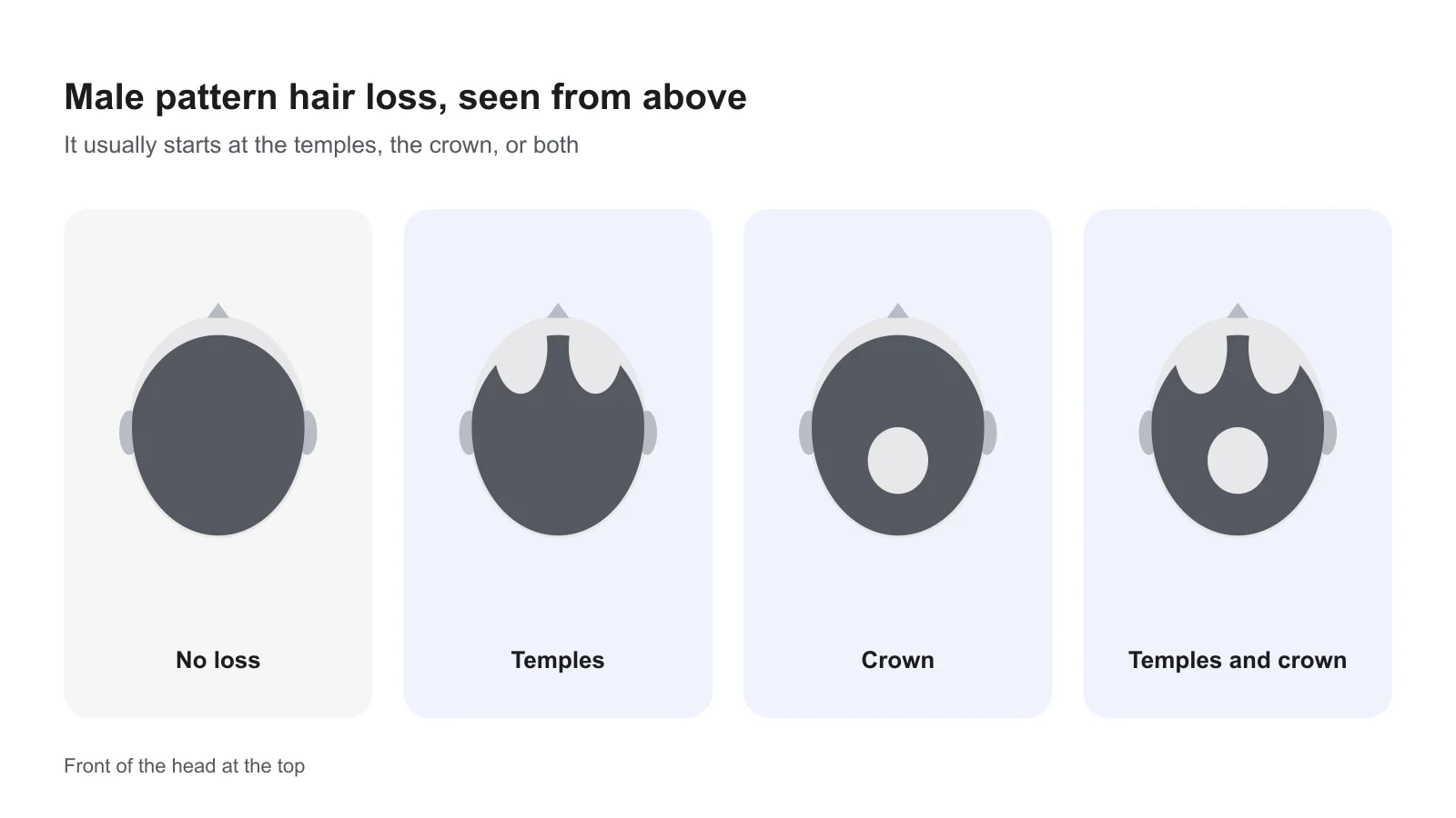 Four tops of heads seen from above: full hair, thinning at the temples, thinning at the crown, and thinning at both.